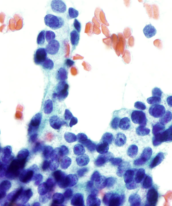 05 : Salivary Gland Acinic Cell Carcinoma