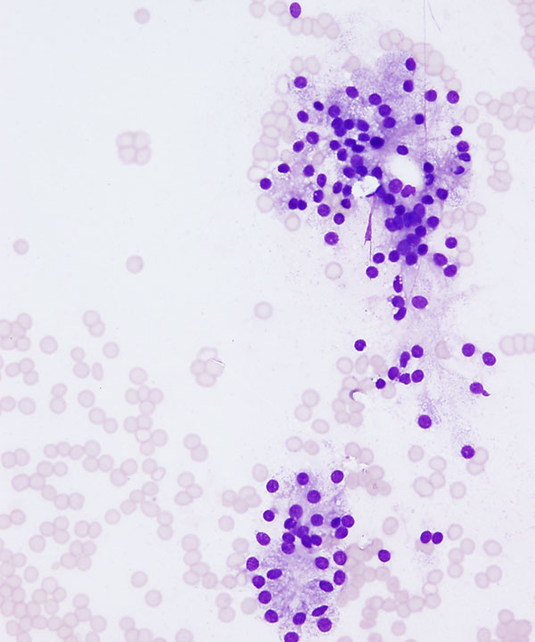 08 : Salivary Gland Acinic Cell Carcinoma