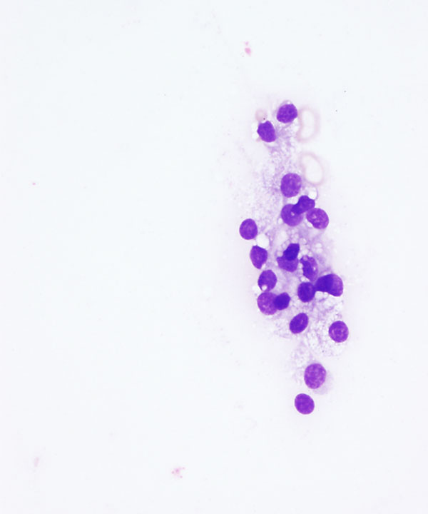 09 : Salivary Gland Acinic Cell Carcinoma
