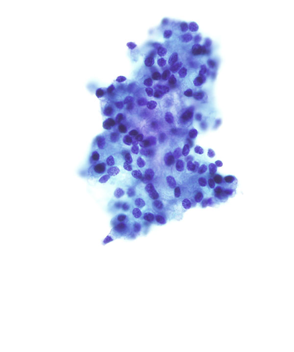 10 : Salivary Gland Acinic Cell Carcinoma