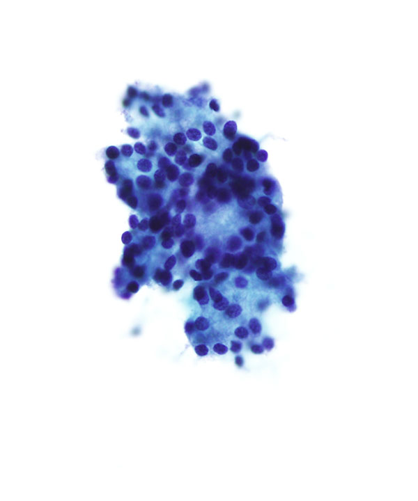 11 : Salivary Gland Acinic Cell Carcinoma