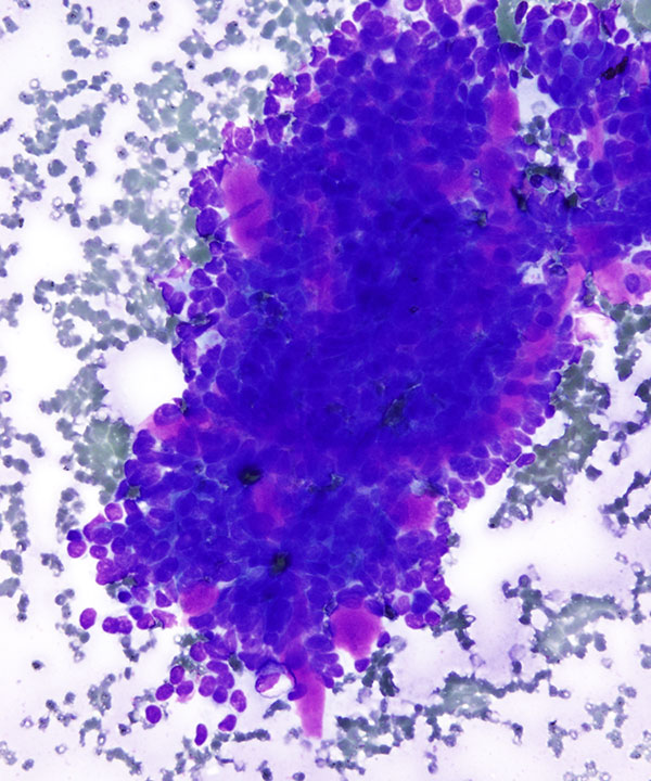 02 : Salivary Gland Adenoid Cystic Carcinoma