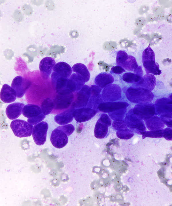 03 : Salivary Gland Adenoid Cystic Carcinoma