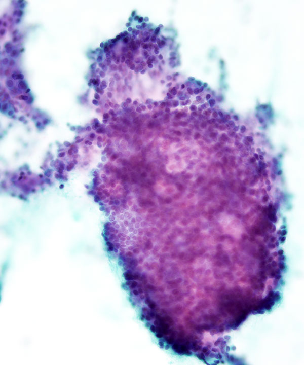 04 : Salivary Gland Adenoid Cystic Carcinoma