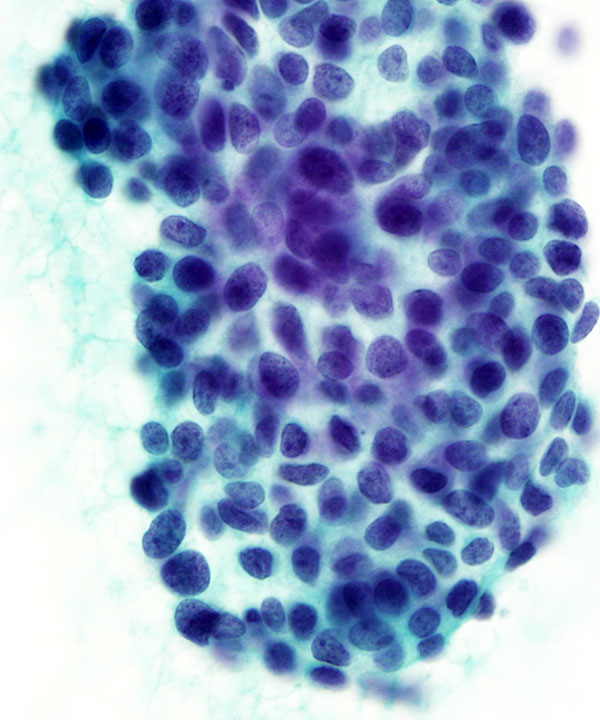 05 : Salivary Gland Adenoid Cystic Carcinoma