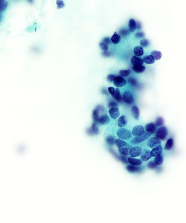 06 : Salivary Gland Adenoid Cystic Carcinoma