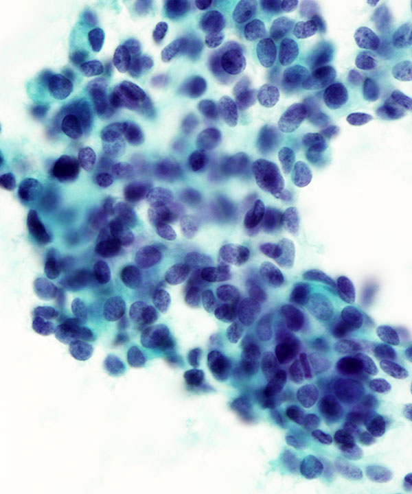 07 : Salivary Gland Adenoid Cystic Carcinoma