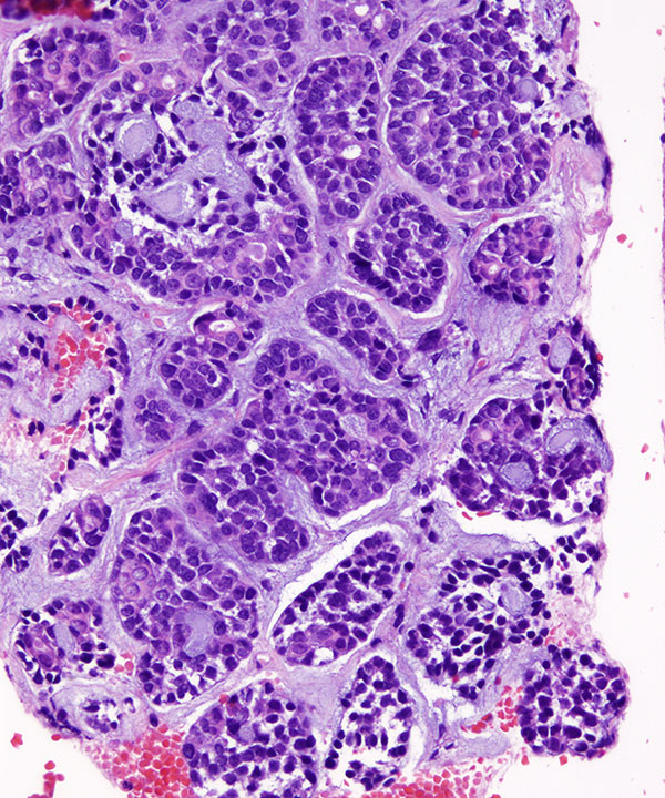 08 : Salivary Gland Adenoid Cystic Carcinoma