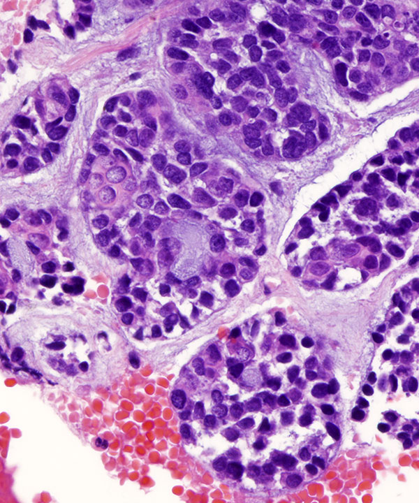 09 : Salivary Gland Adenoid Cystic Carcinoma