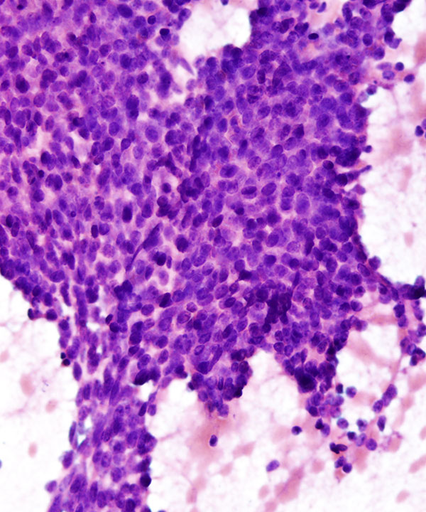 11 : Salivary Gland Adenoid Cystic Carcinoma