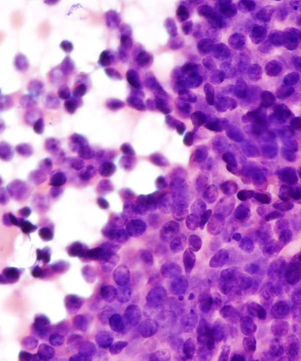 12 : Salivary Gland Adenoid Cystic Carcinoma