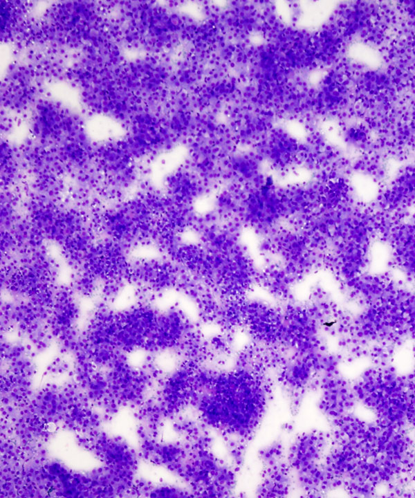 image showing 'Mammary analogue secretory carcinoma'