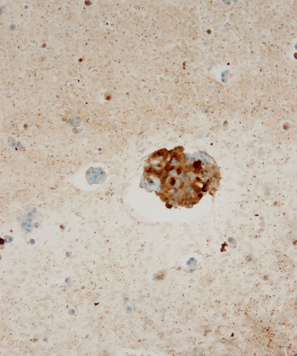 12 : Salivary Gland MASC