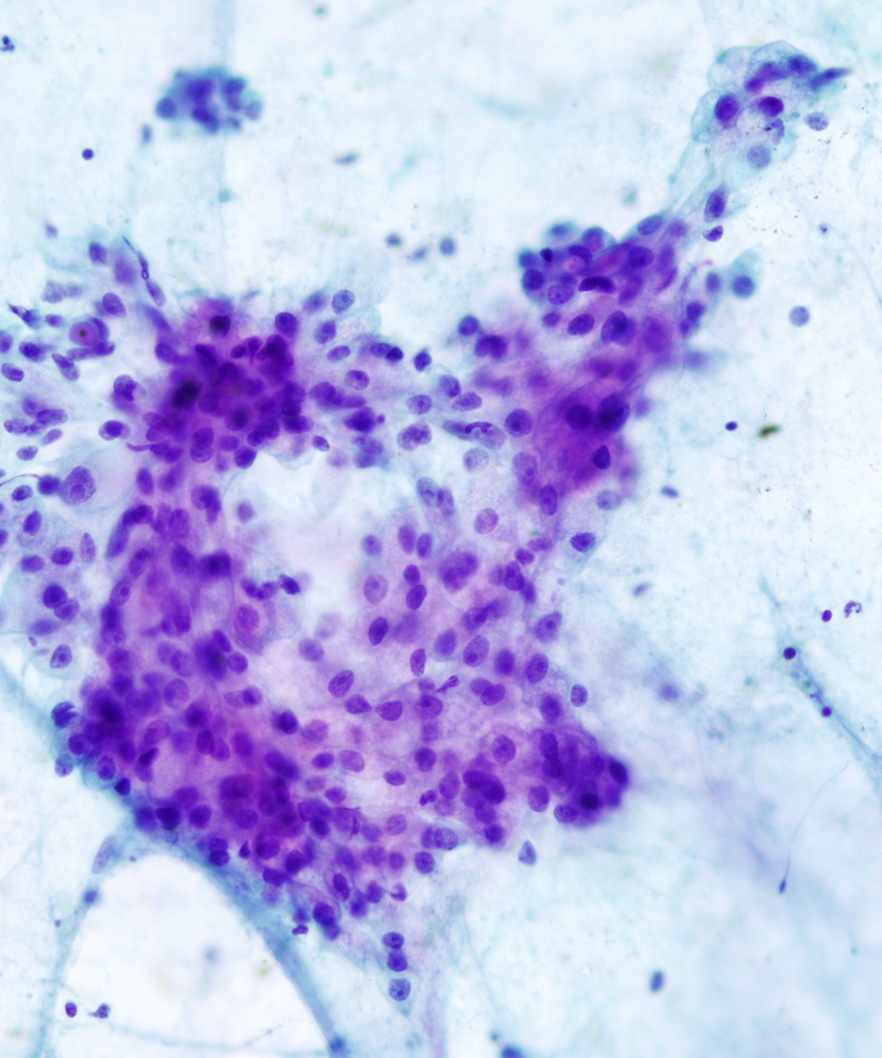 03 : Salivary Gland Mucoepidermoid Carcinoma
