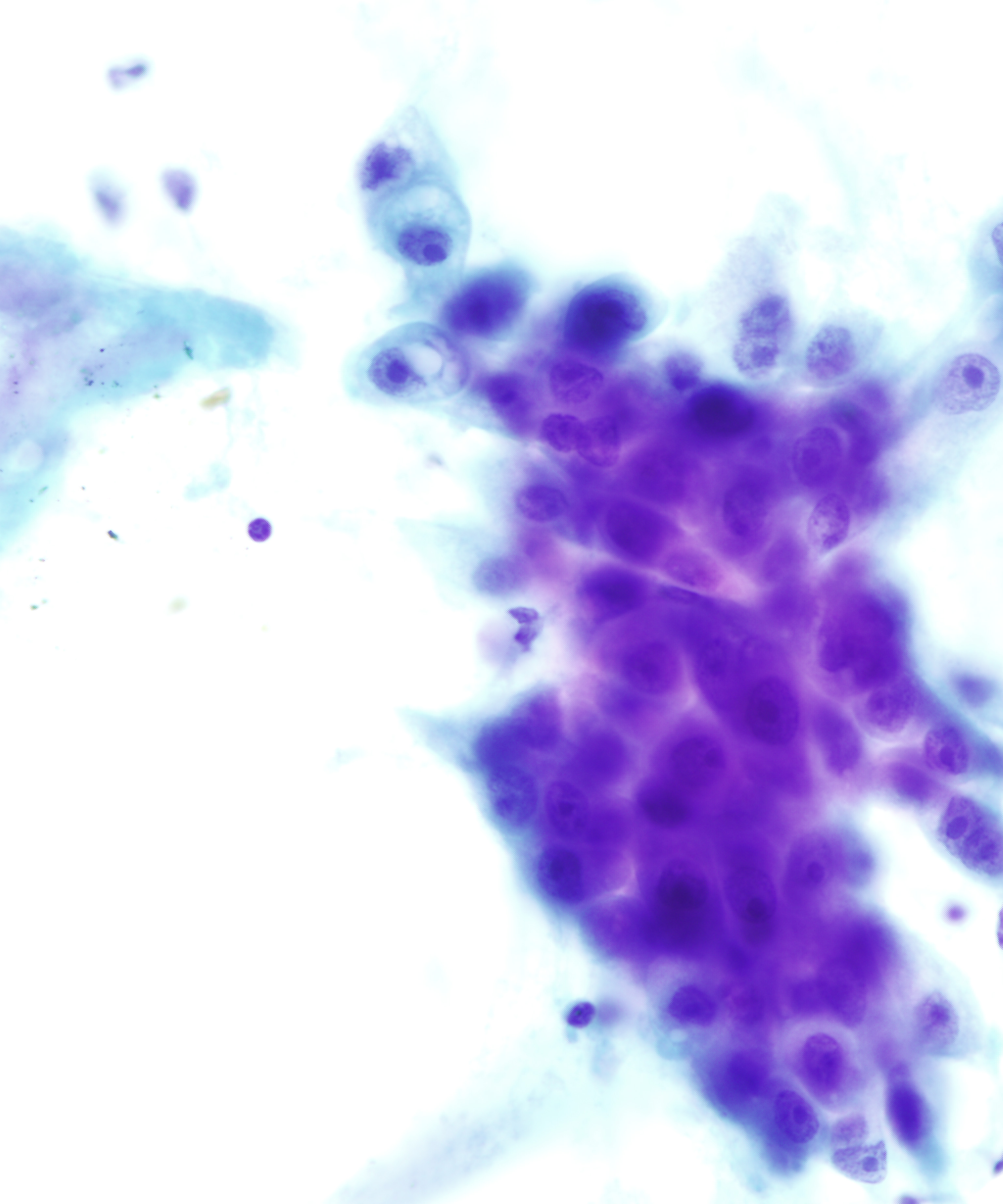 04 : Salivary Gland Mucoepidermoid Carcinoma