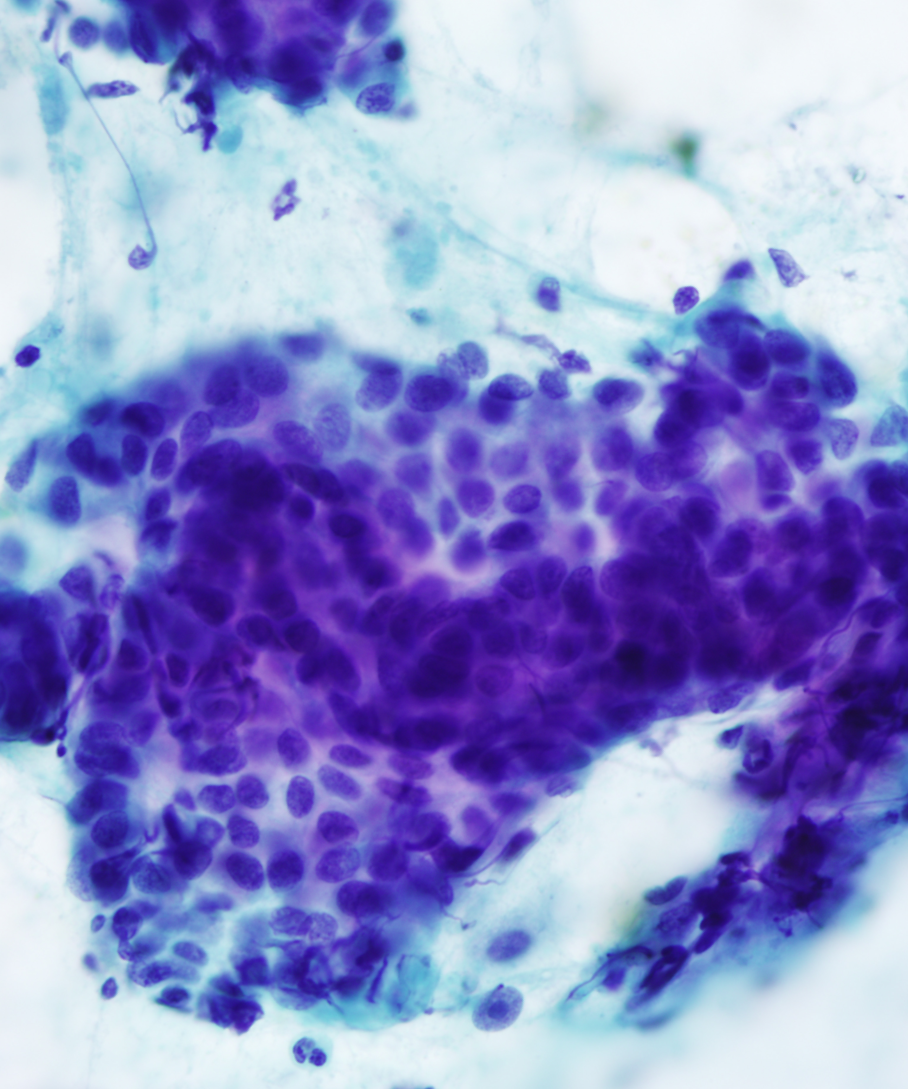 05 : Salivary Gland Mucoepidermoid Carcinoma