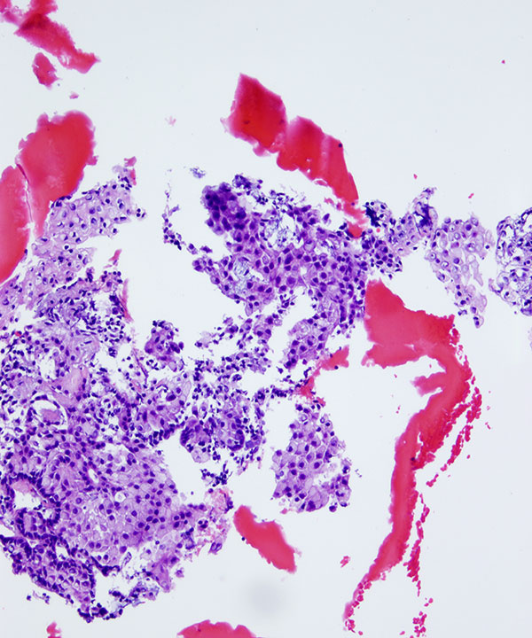 07 : Salivary Gland Mucoepidermoid Carcinoma