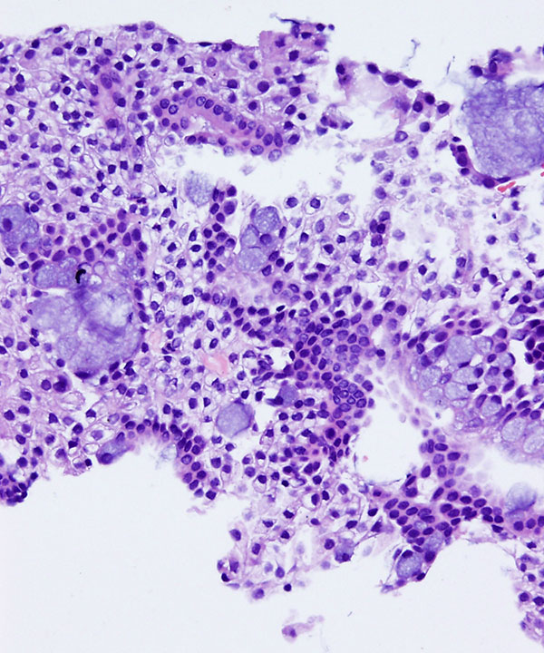 08 : Salivary Gland Mucoepidermoid Carcinoma