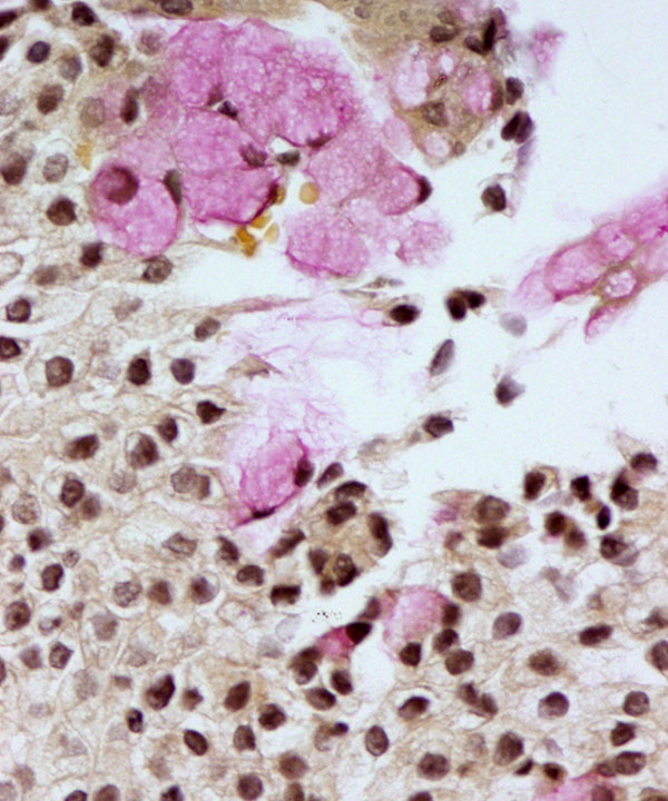 09 : Salivary Gland Mucoepidermoid Carcinoma