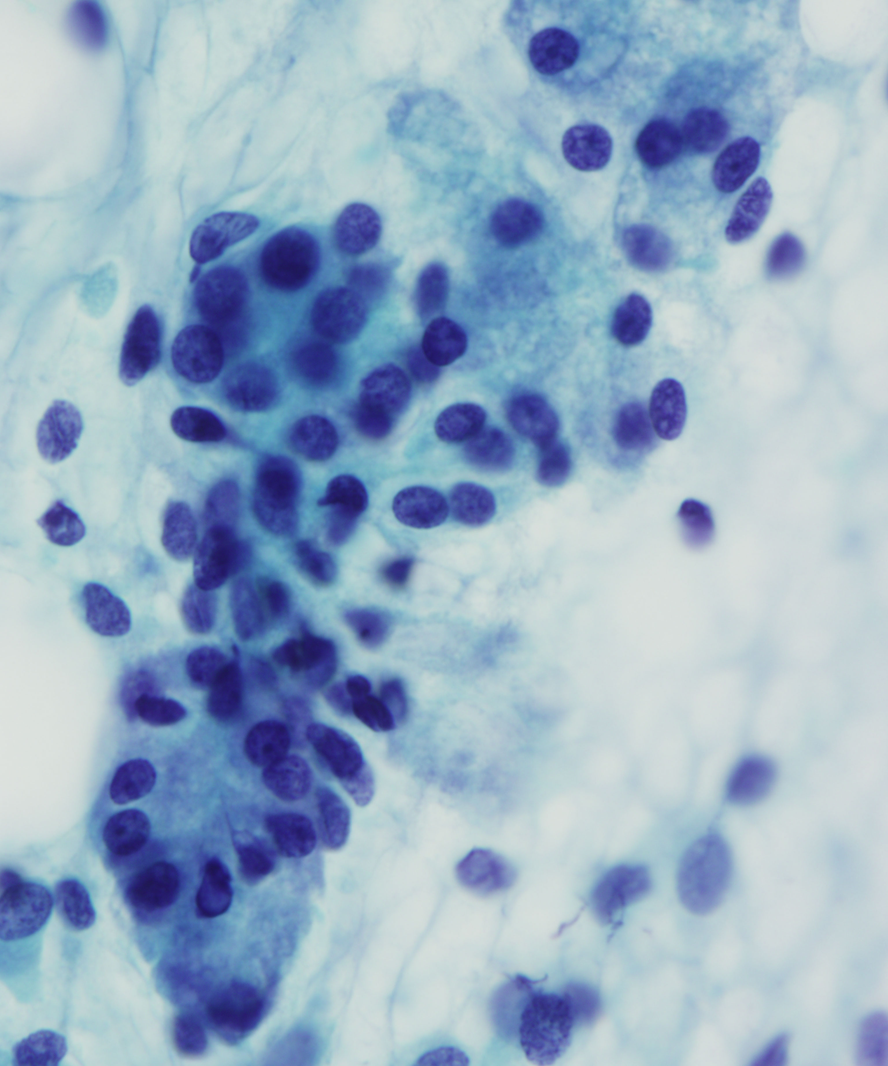 06 :  Salivary Gland Pleomorphic Adenoma