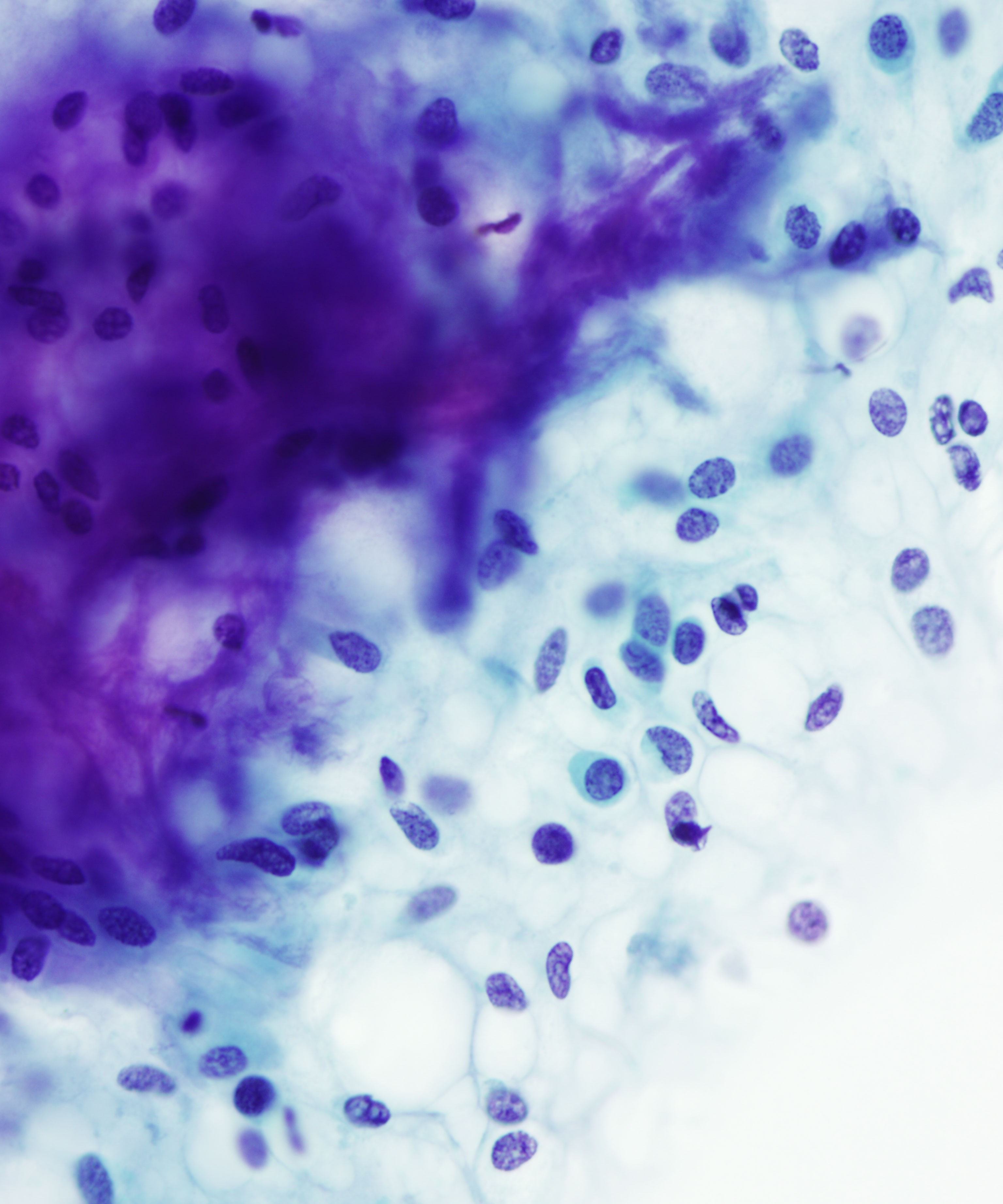 07 :  Salivary Gland Pleomorphic Adenoma