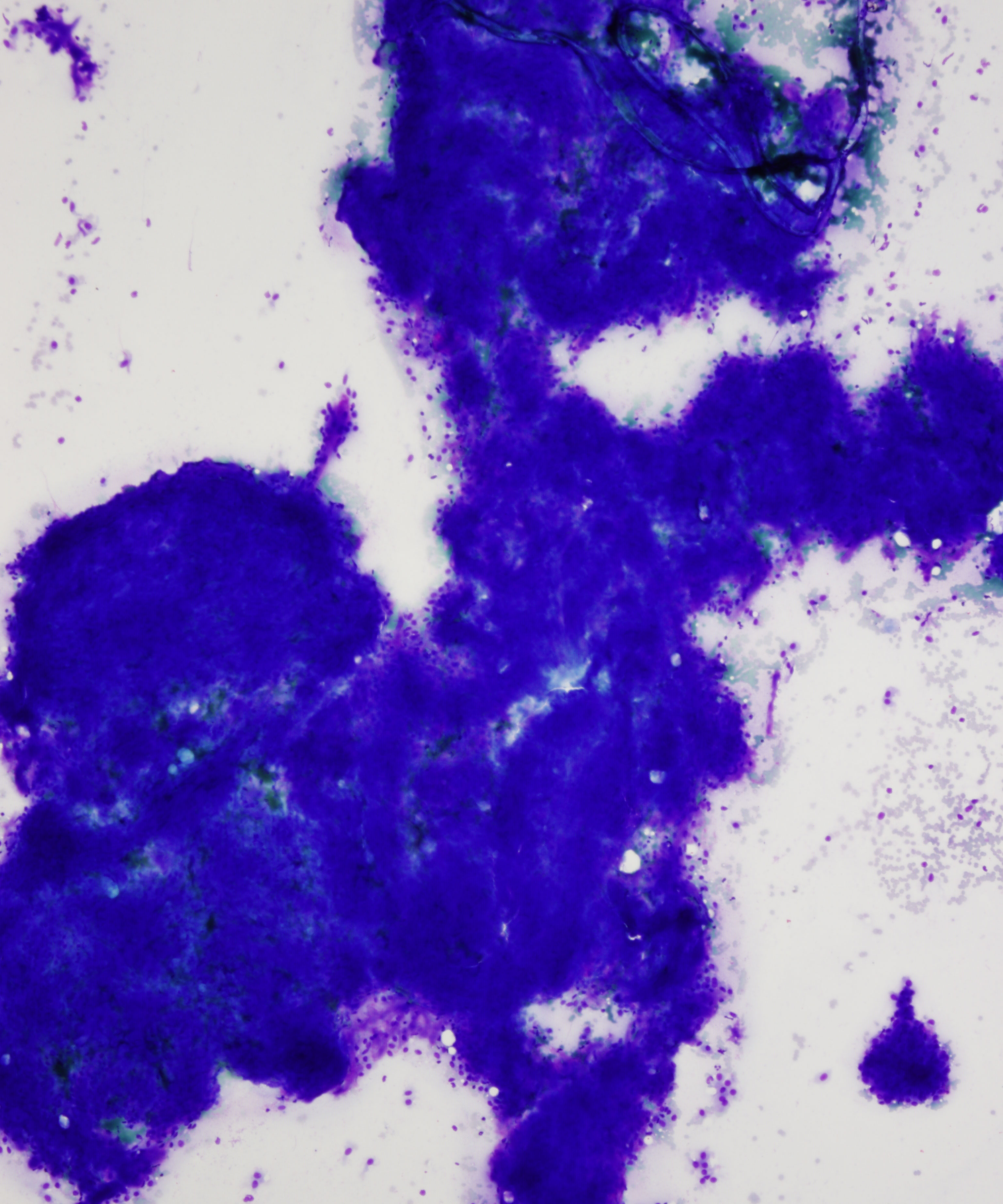 08 :  Salivary Gland Pleomorphic Adenoma