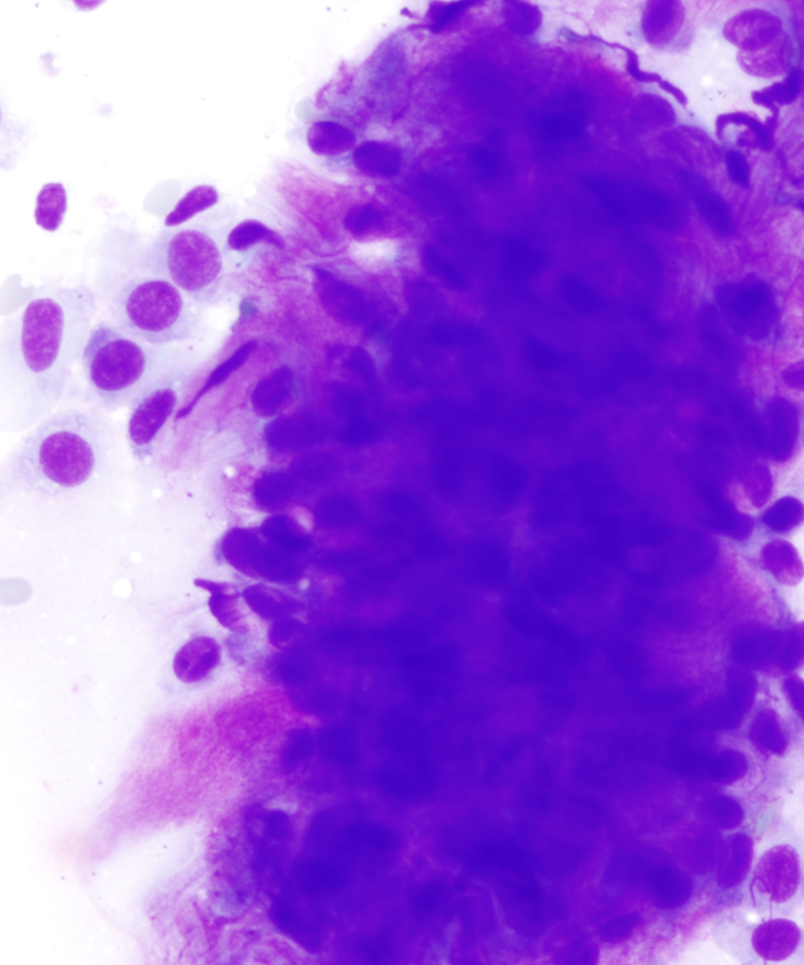 09 :  Salivary Gland Pleomorphic Adenoma