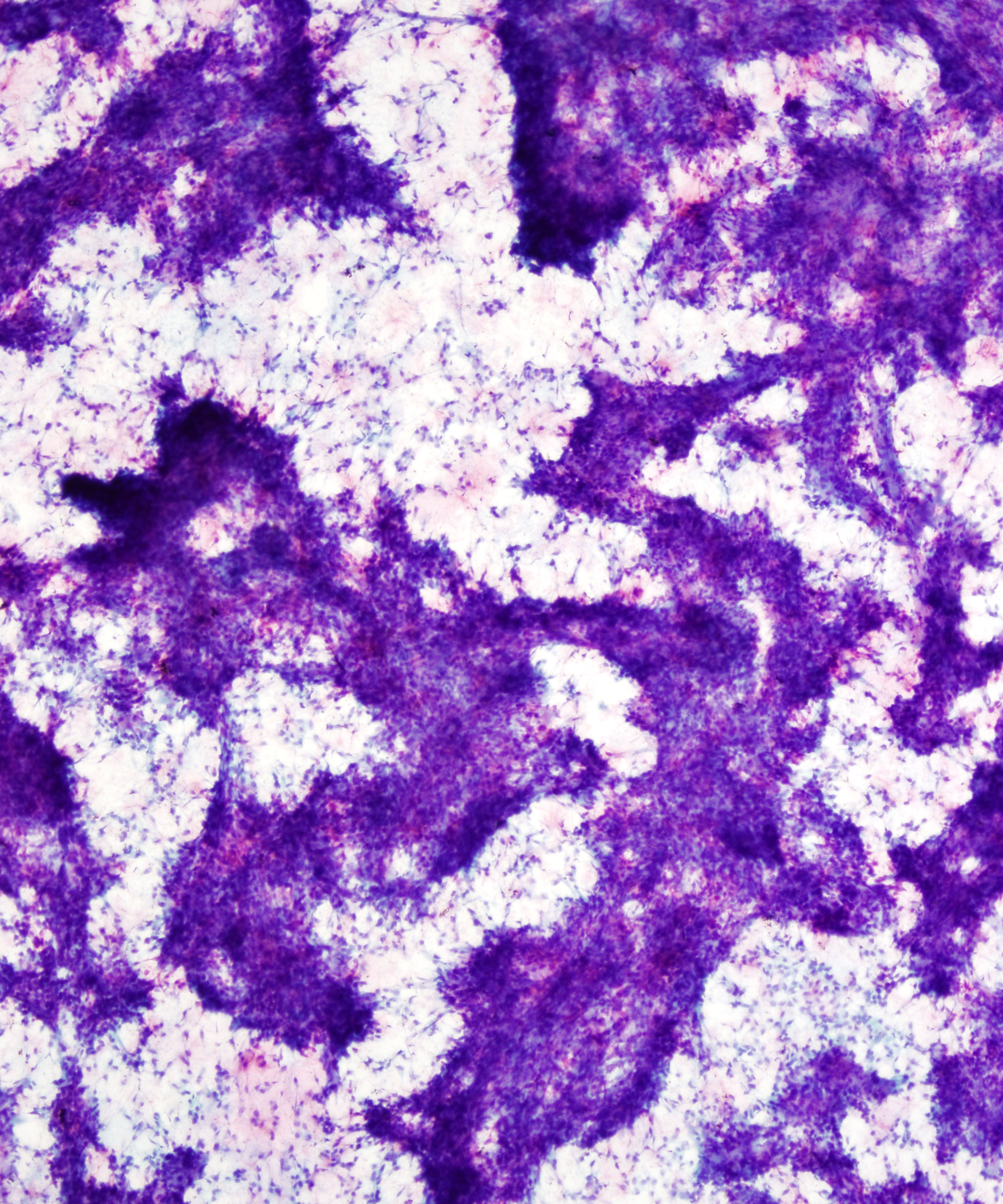 10 :  Salivary Gland Pleomorphic Adenoma
