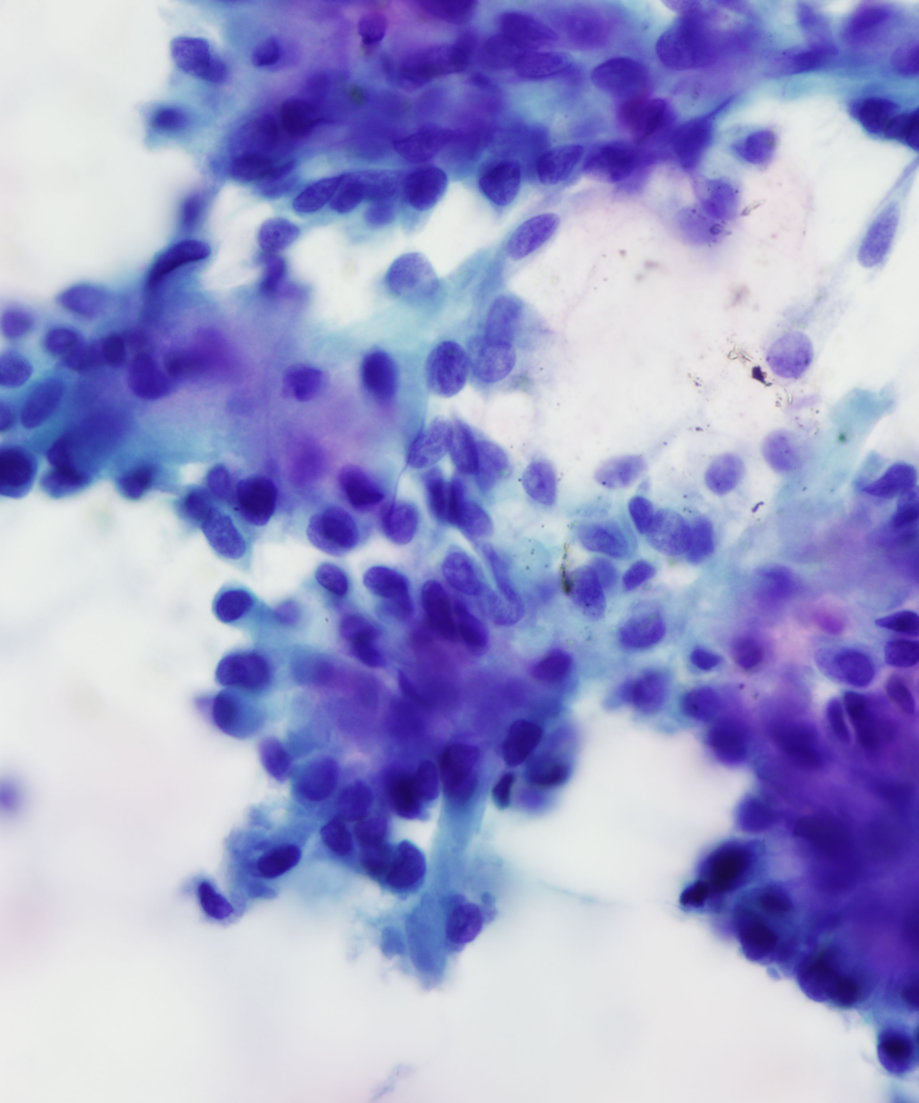 11 :  Salivary Gland Pleomorphic Adenoma
