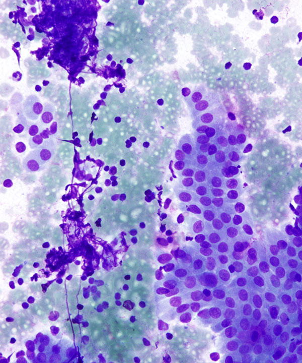 image showing 'Warthin Tumor'