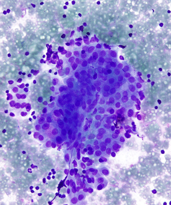 02 : Salivary Gland Warthin Tumor