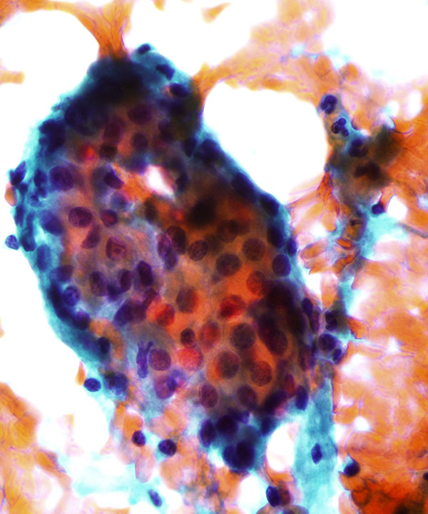 03 : Salivary Gland Warthin Tumor