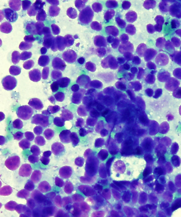 02 : Soft Tissue Alveolar Rhabdomyosarcoma