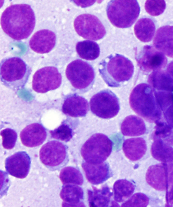 03 : Soft Tissue Alveolar Rhabdomyosarcoma