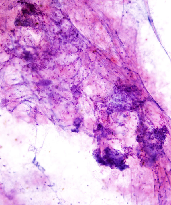 02 : Soft Tissue Angiolipoma