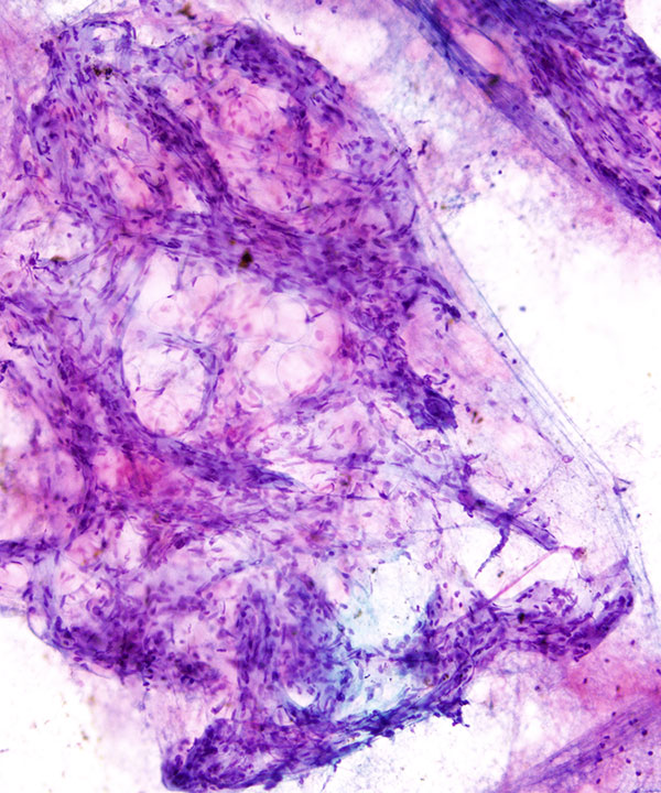 04 : Soft Tissue Angiolipoma