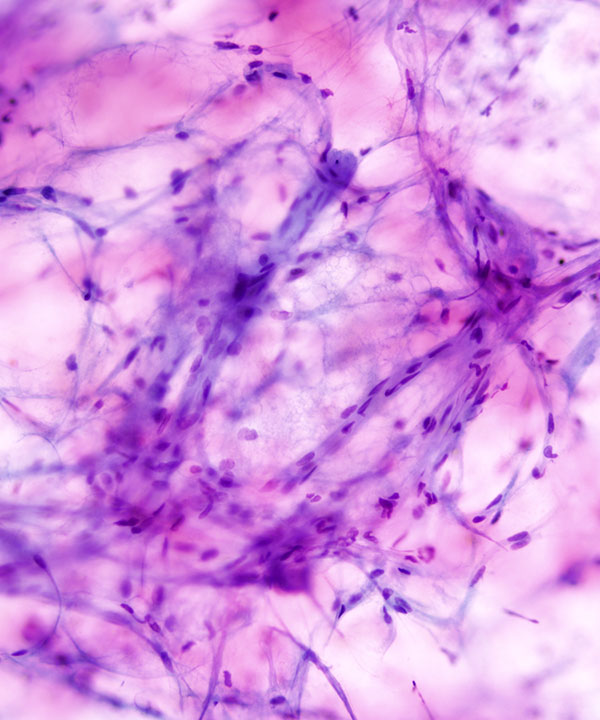 05 : Soft Tissue Angiolipoma