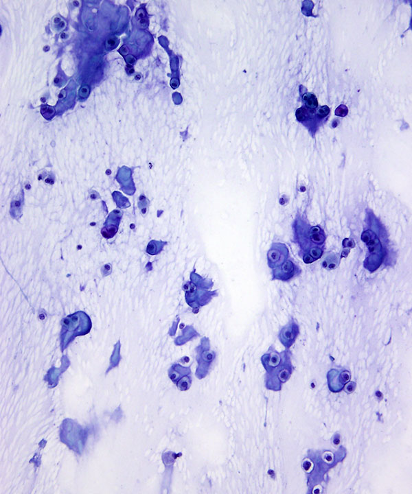 image showing 'Chondroma'