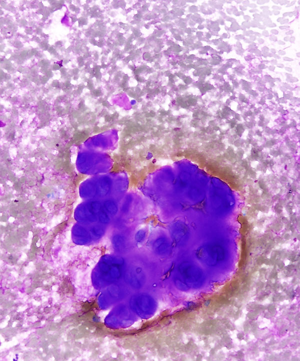 2 : Soft Tissue Chondroma