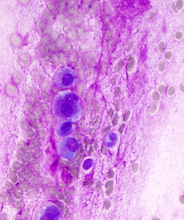 3 : Soft Tissue Chondroma