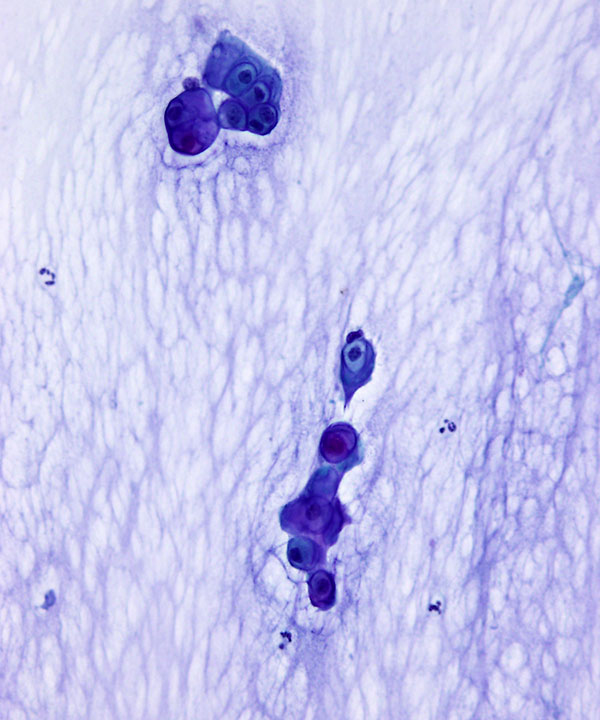 6 : Soft Tissue Chondroma