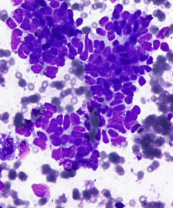 image showing 'Desmoplastic small round cell tumor (DSRCT)'