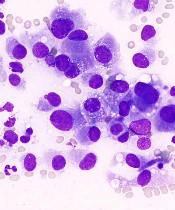 02: Bone & Soft Tissue Epithelioid Angiosarcoma