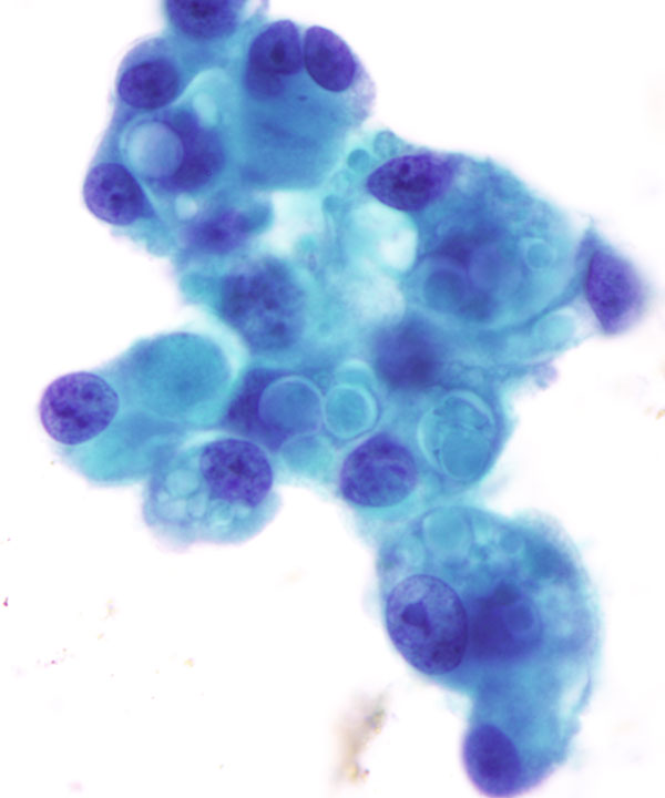 03: Bone & Soft Tissue Epithelioid Angiosarcoma