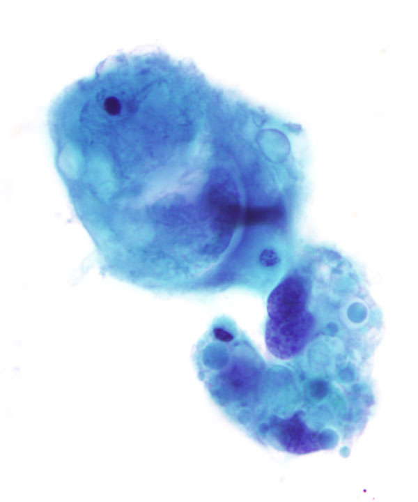 04: Bone & Soft Tissue Epithelioid Angiosarcoma