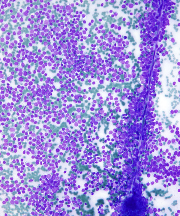 image showing 'Ewing Sarcoma'