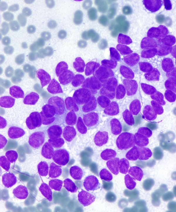 03 : Soft Tissue Ewing Sarcoma