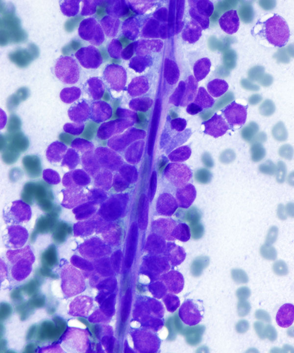 05 : Soft Tissue Ewing Sarcoma