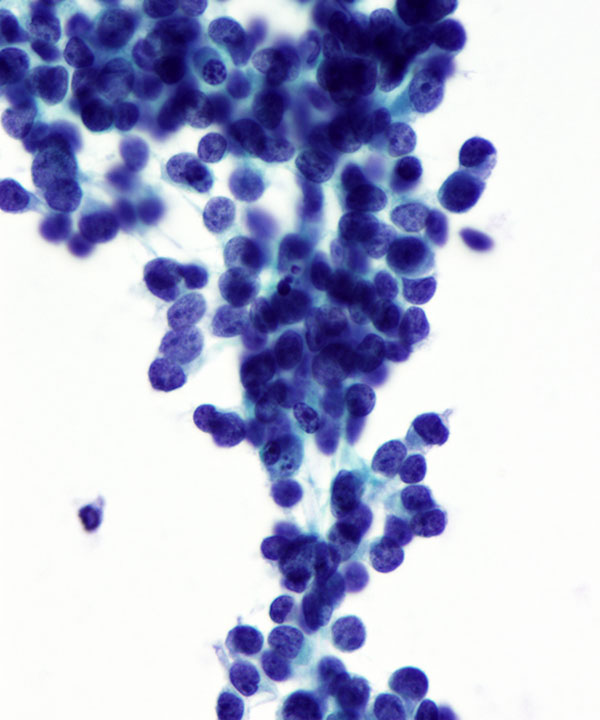 06 : Soft Tissue Ewing Sarcoma