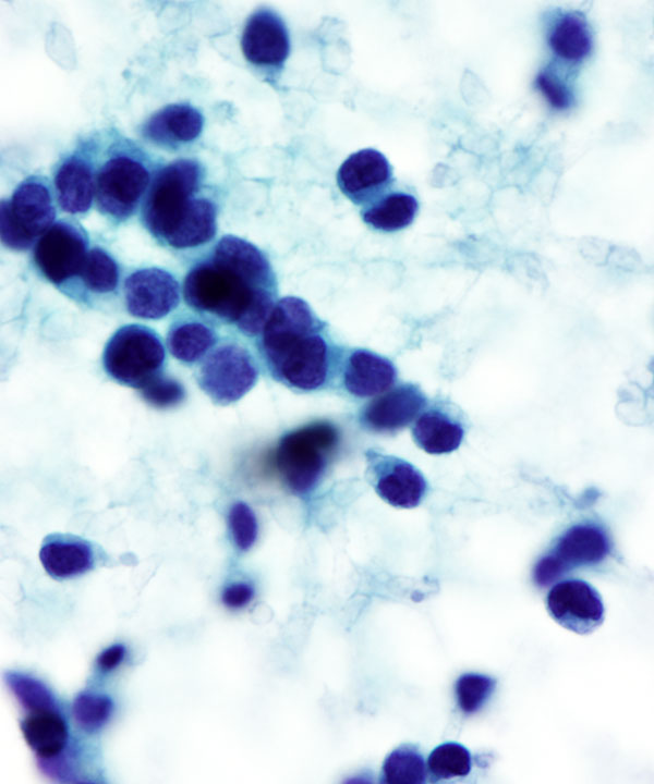 08 : Soft Tissue Ewing Sarcoma